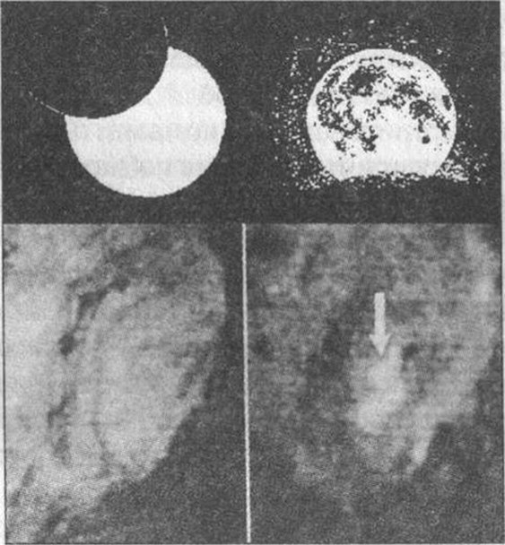 Рис. 14. Облака пыли над Луной: «усы света» вдоль края Луны во время солнечного затмения 17 июня 1890 года (вверху слева); тень Земли на пылевой оболочке Луны во время лунного затмения 16 июля 1954 г. (вверху справа); нормальный вид кратера Лангрен 29 декабря 1992 г. (внизу слева) и тот же кратер через сутки с облаком пыли (внизу справа)